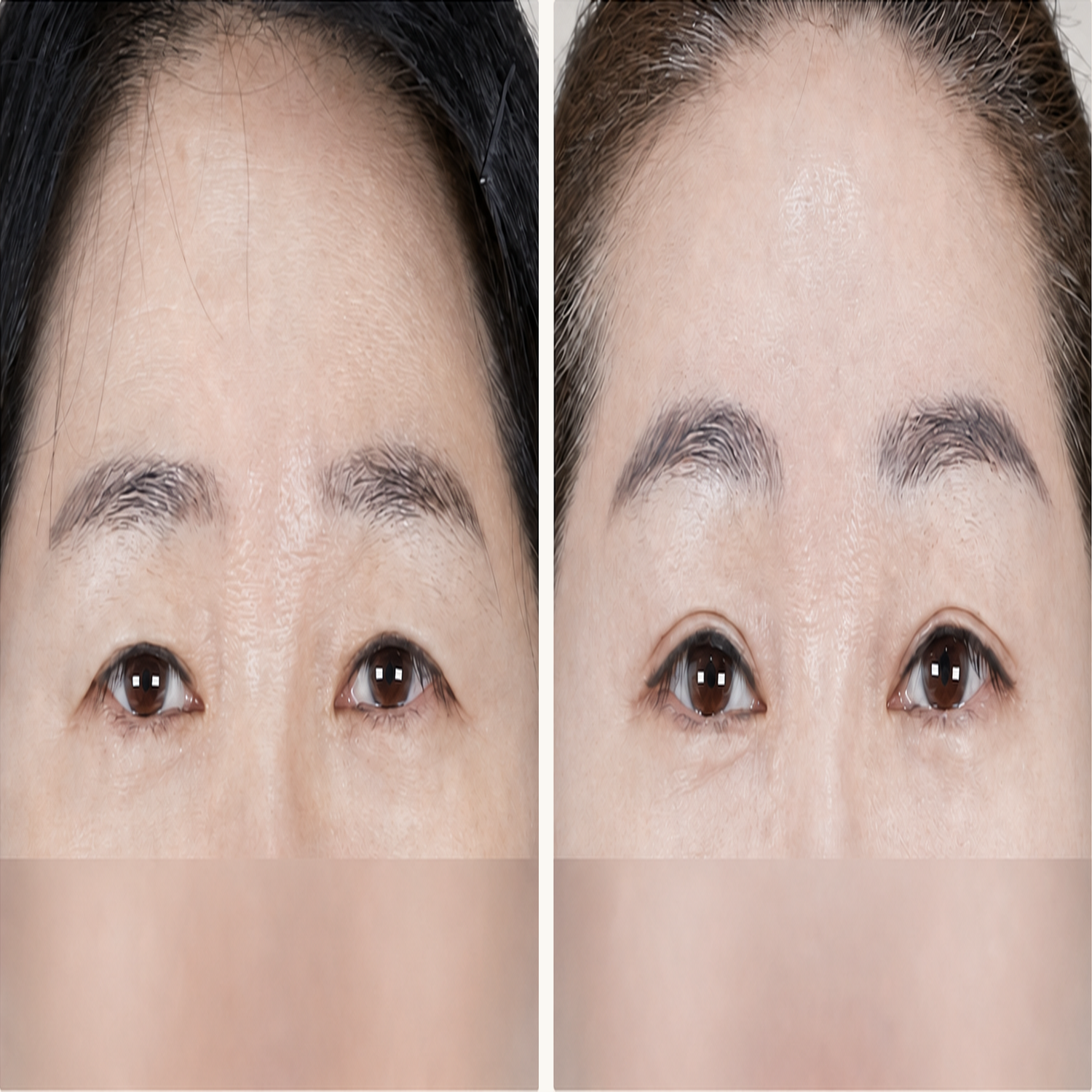Forehead lift and ptosis correction before and after